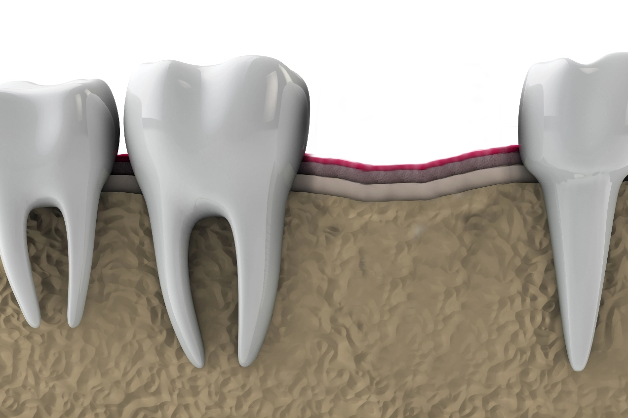 bone-grafting