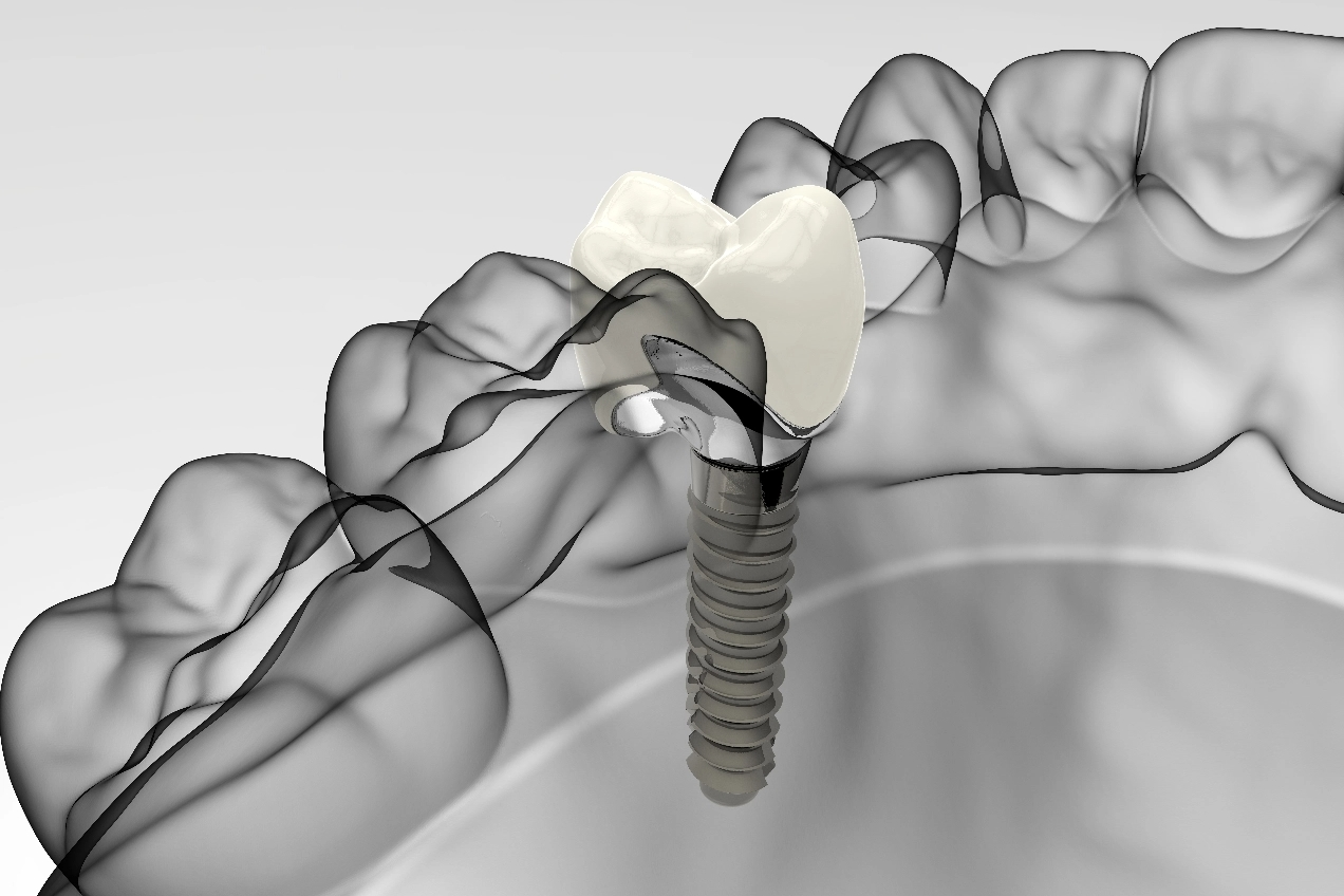 what-is-a-dental-implant